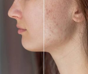From Scars To Smooth Skin: The Magic Of Laser Resurfacing